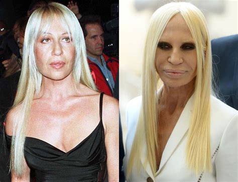 what happened to donatella versace face|Donatella Versace before and after surgery.